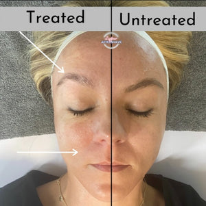 Cryo Anti-Aging Facial