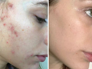 HydraFacial - Teenage Acne