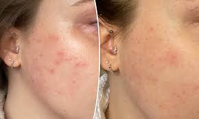 HydraFacial - Teenage Acne