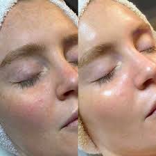 HydraFacial - Teenage Acne