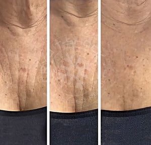 Cryo Neck Slimming