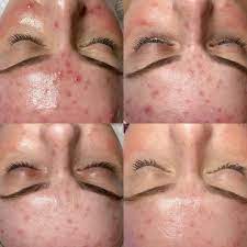 HydraFacial - Teenage Acne